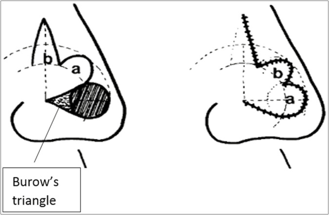 Bilobed Flaps: An Esthetic Method of Reconstructing Circular Defects - PMC