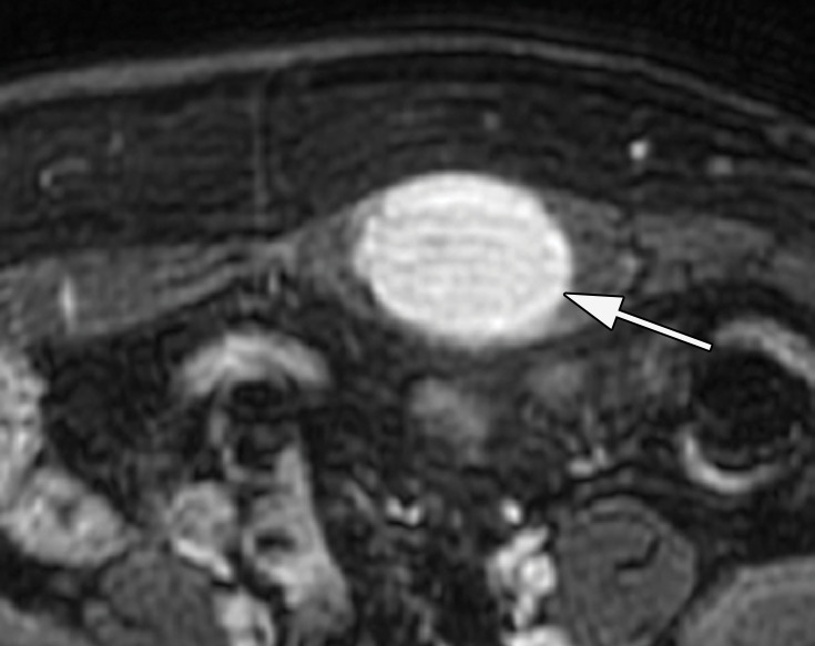Desmoid tumor in the abdominal wall of a 35-year-old woman, which was confirmed on the basis of percutaneous biopsy. (a) Axial CT image shows a hyperenhancing abdominal wall mass centered in the left rectus sheath (arrow). (b–d) Axial nonenhanced T1-weighted MR images show a hypointense mass. After administration of a gadolinium contrast agent, there is progressive homogeneous enhancement of the mass (arrow in b–d) on sequential arterial phase (c), portal venous phase (not shown), and delayed phase (d) images. (e) US image shows a hypovascular hypoechoic mass (arrow).