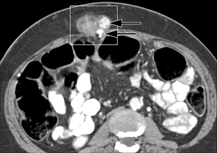 Sister Mary Joseph nodule in a 60-year-old woman with metastatic ovarian serous adenocarcinoma. Axial CT image shows umbilical lymph node metastasis (square outline) from an ovarian serous cancer. Note the calcifications (arrows), which mimic metastatic disease elsewhere in this patient (not shown).