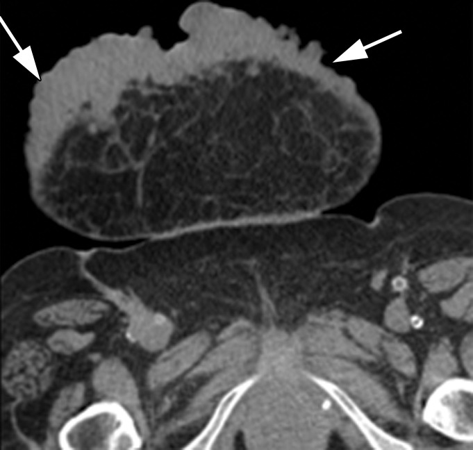 Variable appearances of abdominal wall sarcomas in six different patients. Compare the appearances of discrete palpable abdominal wall masses (a–c) to those of superficial ulcerative masses (d–f). (a) Axial CT image in a 38-year-old man shows a well-circumscribed small epithelioid sarcoma (arrow) in the subcutaneous fat (thought to be an inguinal hernia on examination). (b) Axial CT image in a 33-year-old man shows a leiomyosarcoma (arrows) deep in the underlying muscle of the abdomen (the patient also had a tumor in the right thigh [not shown]). (c) Axial CT image in a 21-year-old man shows a large rhabdomyosarcoma (arrow). The patient also had a tumor in the left thigh (not shown). (d) Axial CT image in a 24-year-old man shows a superficial dermatofibrosarcoma protuberans (arrow) that is not grossly ulcerative at imaging, but physical examination showed edematous skin and bleeding. (e) Axial CT image in a 71-year-old woman shows a superficial epithelioid angiosarcoma (arrows) that manifested as a neglected ulcerative wound at presentation. (f) Axial CT image in a 62-year-old woman shows a deep and infiltrating synovial sarcoma (arrows) that manifested as a neglected ulcerative wound at presentation. All diagnoses were confirmed by means of surgical resection or biopsy.