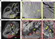 Hierarchical phase-contrast tomography scans of ventricular myocardium in
(A–C) control and (D–F) diseased heart. (A, D) Long-axis views
show the extent of myocardial infarction (MI) in the diseased heart, together
with lipomatous hypertrophy, bright areas of calcification in the aortic valve
and mitral annulus (yellow arrowheads in D), and stent in the right coronary
artery (red arrowhead in D). (B, E) Zoom scans of boxes in A and D show the high
spatial resolution obtained even at this voxel size and the extensive nature of
the myocardial infarction that lies immediately beneath the trabecular
myocardium (T). (C, F) High-spatial-resolution scans of the boxed areas in B and
E show differences in myocardial aggregates, which are separated by replacement
fibrosis in the diseased heart (yellow arrowheads in F) but tightly packed in
the control heart. Ao = aorta, C = compact myocardium, LA = left atrium, LV =
left ventricle, RV = right ventricle.