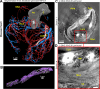 (A, B) Three-dimensional cinematic renderings and (C, D) images from
hierarchical phase-contrast tomography (HiP-CT) show segmentation of the
coronary arterial and venous tree in the diseased heart. (A) The heart is viewed
on its apex to show the course of the major coronary arteries and veins as well
as smaller vessels such as the sinoatrial nodal artery (SNA). The coronary
vasculature is lifted away from the epicardial surface by lipomatous
hypertrophy, lengthening the penetrating arteries (see also Fig 1). Box
indicates the location of the stent shown in B; line indicates the cross-section
shown in C. (B) Cinematic rendering of one of the coronary stents, along with
surrounding calcification (purple), shows feasibility of imaging both soft and
hard tissue with minimal artifacts. (C) High-spatial-resolution local tomography
of the left descending coronary artery shows atherosclerotic plaque including
calcification (box). (D) Digital zoom scan of box in C shows details of the
atherosclerotic plaque and calcification within the intima. Adip = adipose
tissue, Adv = tunica adventitia, Ao = aorta, Ath = atherosclerosis, C =
calcification, LAD = left anterior descending coronary artery, Lum = lumen, Med
= tunica media, RCA = right coronary artery, VV = vasa vasorum.