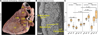 (A) Three-dimensional (3D) cinematic rendering from hierarchical
phase-contrast tomography (HiP-CT) of the control heart, viewed from the left
posterior aspect, with epicardial fat digitally removed using thresholding,
shows the left atrium and the left atrial appendage (LAA), which can be seen
running over the circumflex coronary artery (CX). This anatomic relationship is
a key landmark for interventional closure of the left atrial appendage with
devices. Ao = aorta, CS = coronary sinus, LAD = left anterior descending
coronary artery, LPV = left pulmonary vein, LV = left ventricle, PT = pulmonary
trunk. (B) High-spatial-resolution local HiP-CT scan of the wall of the left
atrial appendage in the control heart (view plane is given by the dashed line in
A) shows histologic spatial resolution of endocardial, myocardial, and
epicardial layers, allowing measurement of thickness (lines). (C) Box and
whiskers plots show the thickness of the endocardium (Endo), myocardium (Myo),
and epicardium (Epi) in the left and right atria in the control heart and the
diseased heart. Circles indicate individual measurements, the boundaries of
boxes indicate the lower and upper quartiles, the red lines indicate medians,
and the whiskers indicate ranges. Measurements were obtained manually at 15
distinct locations along the left and right atrial walls. Thickness measurements
in the control and diseased hearts, and in right versus left atrium, were
compared using unpaired multiple t tests with multiple comparison correction
applied via the Holm-Sidak method and a set α threshold of .05.
Statistical analysis revealed significant differences (P < .001) in the
thickness of the left and right atrial endocardium within the control heart and
within the diseased heart and in the thickness of the left and right atrial
epicardium between the control heart and the diseased heart.