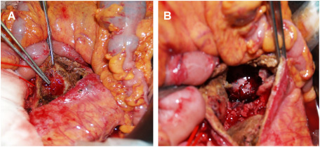 Fig. 2 Intraoperative pictures during the staged laparotomy. (A) Two 3-mm wide fistulas between the anterior wall of the abdominal aortic aneurysm and the third part of the duodenum are identified inside the aneurysm. (B) A deployed stent graft is seen inside the aneurysm, which is isolated and uncontaminated with intestinal fluid.