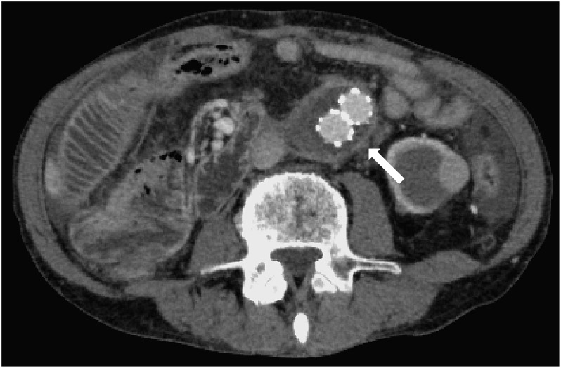 Fig. 3 Follow-up computed tomography scanning three years after endovascular aneurysm repair. It shows a shrinkage of abdominal aortic aneurysm (white arrow) and no infectious signs around the aneurysm covered with the omentum.