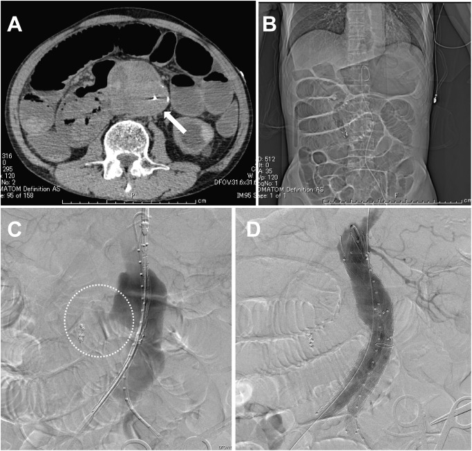 Fig. 1 Computed tomography (CT) and digital subtraction angiography (DSA) taken in an interventional radiology suite. (A) CT image shows an 80-mm infrarenal abdominal aortic aneurysm (AAA) (white arrow) and the storage of intestinal gas, leading to suspicion of ileus. The definitive diagnosis of aorto-duodenal fistula cannot be made. (B) DSA revealed AAA ruptured into the duodenum (dotted circle). (C) After deployment of the stent graft system, DSA shows the successful exclusion of ruptured AAA.