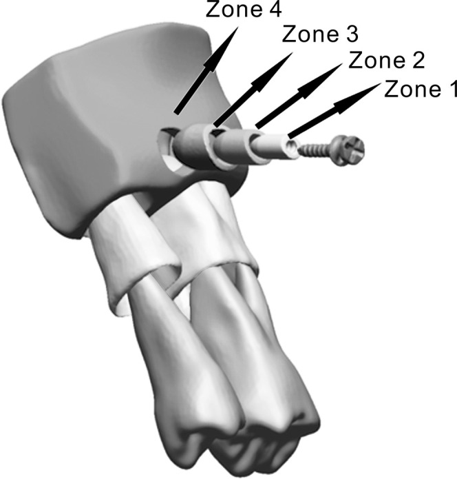 Figure 1. The finite element model consisted of the orthodontic mini-implant, adjacent teeth, periodontal ligament, and bone segment surrounding these structures. The bone was divided into four zones according to distance from the implant surface: zone 1 (0.0–0.5 mm), zone 2 (0.5–1.0 mm), zone 3 (1.0–1.5 mm), and zone 4 (the rest of the bone segment).