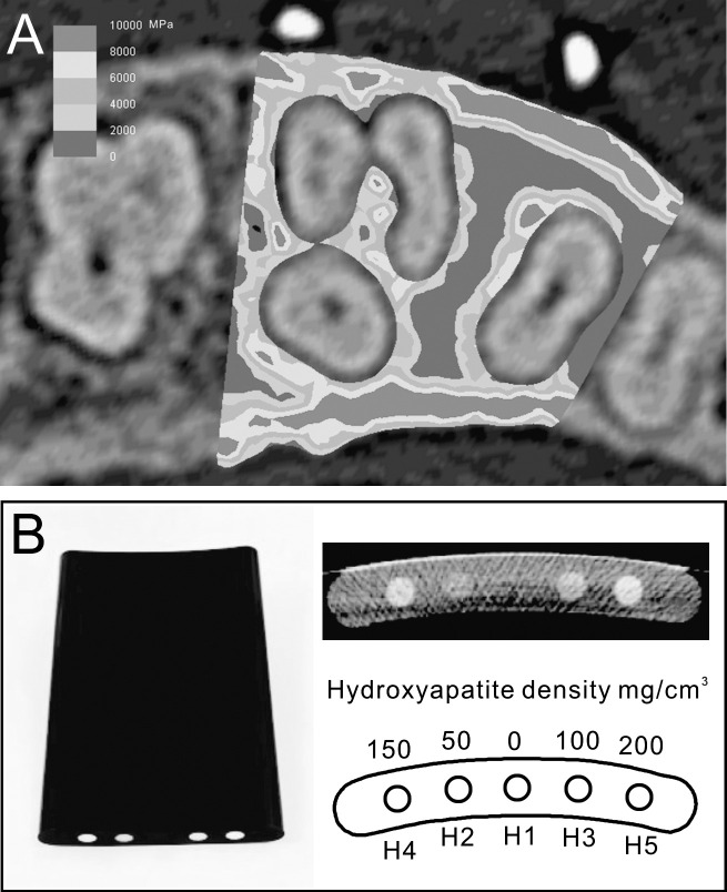 Figure 3. (A) Mesiodistal section of the finite element model showing the heterogeneous distribution of bone properties. Bone properties were derived from the preoperative computed tomography image. (B) To develop a formula that converts Hounsfield units to bone densities, a phantom with five different densities was scanned and calibrated.