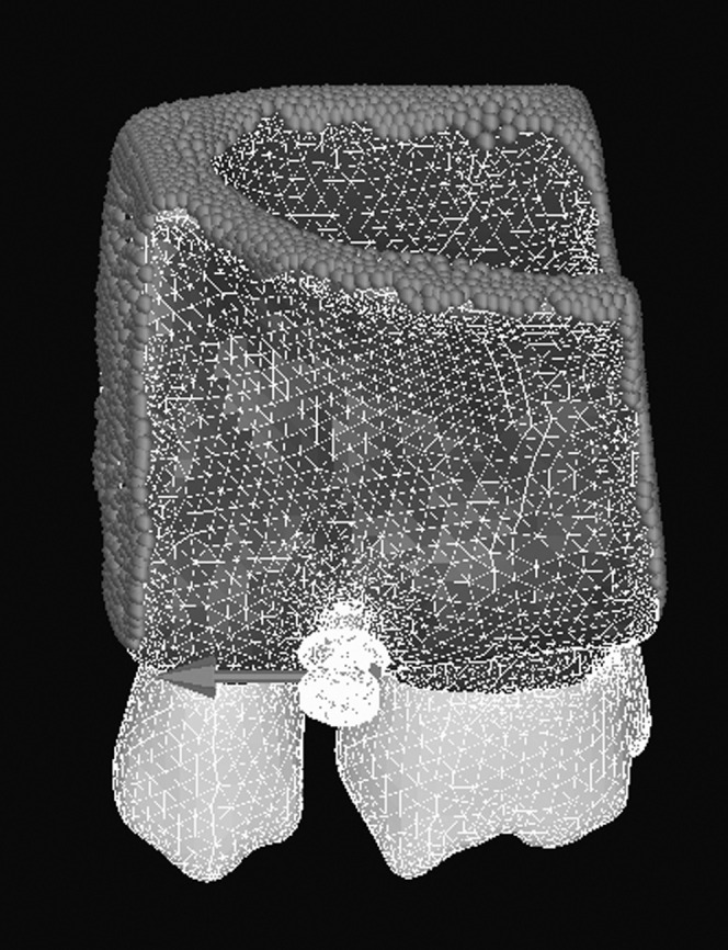 Figure 4. The finite element model after meshing. The constraints (red dots) are assigned to bone cutting surfaces, and a mesial load of 2 N (red arrow) is applied to the head of the implant in the mesial direction.