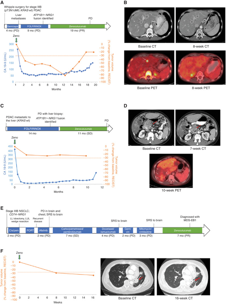 Figure 4. Clinical responses to Zeno. A, Clinical course of a 50-year-old man with ATP1B1–NRG1 fusion–positive PDAC treated with Zeno (top) including tumor volume and CA 19-9 levels during Zeno treatment (bottom). Best overall response is indicated for each therapy, including progressive clinical disease (PD) and partial response (PR) as defined by RECIST v1.1. B, Representative tumor imaging of this patient's liver metastases at baseline and eight weeks into treatment with Zeno. C, Clinical course of a 34-year-old man with ATP1B1–NRG1 fusion–positive PDAC treated with Zeno (top) including tumor volume and CA 19-9 levels during Zeno treatment (bottom). Best overall response is indicated for Zeno [stable disease (SD) as defined by RECIST v1.1]. D, Representative tumor imaging from this patient showing a CT scan of the pancreas performed at baseline and seven weeks into treatment with Zeno, and a PET scan 10 weeks into treatment showing non–FDG-avid liver metastases (no baseline available). E, Clinical course of a 52-year-old man with CD74–NRG1 fusion–positive NSCLC treated with Zeno after six prior lines of systemic therapy and multiple courses of radiation. Best overall response is labeled for each therapy, including clinical PD/SD, and PR as defined by RECIST v1.1. F, Tumor shrinkage in this patient depicted graphically (left) and by representative tumor imaging (right) performed at baseline and 16 weeks into Zeno treatment. Abbreviations: cape, capecitabine; carbo, carboplatin; gem, gemcitabine; MDS-EB1, myelodysplastic syndrome with excess blasts-1; pem, pemetrexed; PORT, postoperative radiotherapy; vin, vinorelbine.