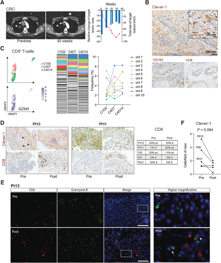 Figure 6. FP-1305–induced antitumor responses are reflected by clonal expansion of systemic effector CD8+ T-cells in a responding patient. A, CT images of a patient (Pt6) with microsatellite-stable (MSS) colorectal carcinoma (six previous lines of therapy). Arrows highlight shrinking lung metastases. Size of the target lesions and change over time are presented in the right-hand graph. B, IHC analyses of Clever-1, CD163, and CD8 (all in brown) in archived rectal carcinoma tissue from the colorectal cancer (CRC) patient. C, Uniform manifold approximation and projection (UMAP) plots of CD8+ T-cell transcriptomes colored by timepoint and expression of granzyme A (GZMA). Abundance of diverse CD8+ T-cell clonotypes (cnt) at cycle 1, D0 (predose), and cycle 4 timepoints D7 and D14. The ten most abundant TCR sequences are colored to show dynamics of specific clones across the different timepoints. D, IHC staining of Clever-1 and CD8 in patient tumor biopsies pre- and post-treatment. Posttreatment biopsies were taken after cycle 3. Arrows point to Clever-1+ liver sinusoids. Quantification of peri- and intratumoral CD8+ T-cells in biopsies are reported by predominant immune cell location. it, intratumoral; pt, peritumoral. E, Immunofluorescence staining of CD8 (red) and granzyme B (green) in pre- and posttreatment biopsies of Pt13 with DAPI nuclear stain (blue). Arrows point to double positive cells. Scale bar, 100 μm. F, Quantification of Clever-1+ macrophages in tumor biopsies pre- and posttreatment. Student's paired two-tailed t test.