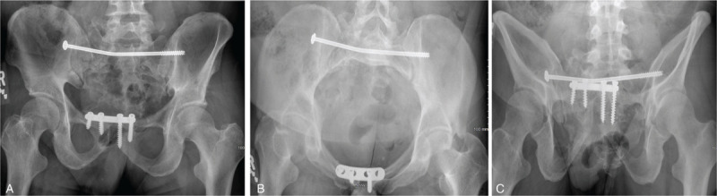 Vertical shear pelvic ring injuries: do transsacral screws prevent ...