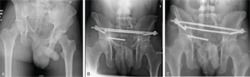 Vertical shear pelvic ring injuries: do transsacral screws prevent ...