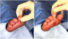 (A shows the foot pre-surgery with bent toes, B depicts post-surgery improvement in toe and foot flexibility after tenotomy and capsule release.)