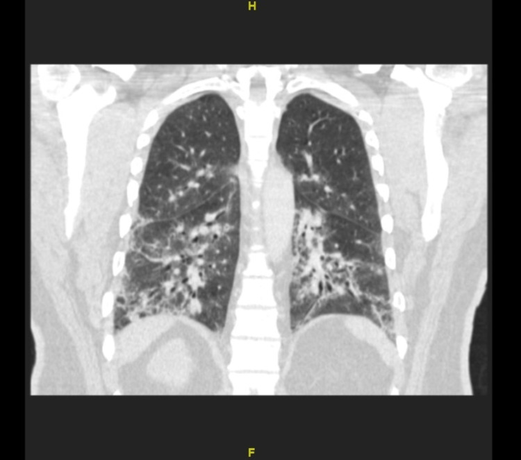 Cryptogenic Organizing Pneumonia Secondary To Mycoplasma Pneumoniae 