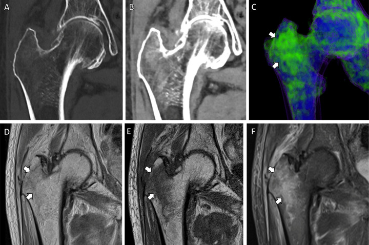 Dual-energy CT–based virtual noncontrast coronal images in an 83-year-old male patient with right-sided hip pain. (A, B) CT scans obtained with bone (A) and soft-tissue (B) windows show bone marrow edema in the right greater trochanter. (C) Bone marrow edema map redemonstrates these findings in precise detail (arrows). Corresponding (D) coronal proton density, (E) coronal T1-weighted, and (F) coronal T2-weighted fat-suppressed MRI scans demonstrate a nondisplaced microtrabecular fracture (arrows) in the same region.