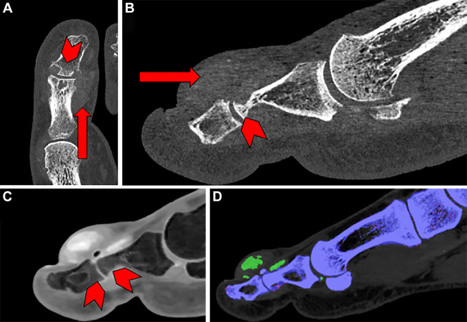 Images in a 58-year-old male patient with pain and swelling of the first digit of the left foot acquired using photon-counting detectors (PCDs). (A) Transverse view and (B) sagittal view show that periarticular mineralization (arrow) can be seen with associated erosive change (arrowhead). (C) Material decomposition acquisition reveals bone edema in the phalanges of the interphalangeal joint (arrowheads). (D) Another color-encoded material decomposition image reveals monosodium urate crystal deposits (green).