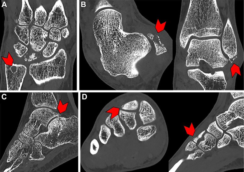 Example photon-counting CT images in patients with various pathologies. (A) Coronal image in a 47-year-old female patient with Kienböck disease. Cystic abnormality can be seen at the fovea of the ulna (arrowhead). (B) Coronal and axial images in a 55-year-old female patient with lateral malleolus fracture. Punctate foci at the tip of the lateral malleolus of the distal fibula (arrowheads) indicate a subacute avulsion fracture. (C) Sagittal image in a 74-year-old male patient with a comminuted transverse fracture of the calcanea body with surrounding patch sclerosis (arrowhead). (D) Sagittal and coronal images in a 17-year-old male patient with dorsal foot pain. A small fracture is seen along the dorsal aspect of the middle cuneiform at the second tarsometatarsal joint (arrowheads).