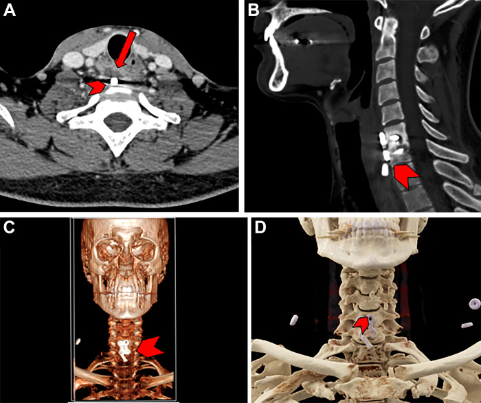 Images in a 30-year-old male patient with a history of anterior cervical discectomy and fusion of the sixth and seventh cervical vertebrae. (A, B) Conventional axial (A) and sagittal (B) CT scans demonstrate the displacement of a screw used for fixation (arrow in A). Also demonstrated is an abnormal lucency (arrowhead) indicative of screw loosening or infection. (C) Traditional three-dimensional (3D) surface reconstruction demonstrates placement of the implant with moderate resolution (arrowhead). (D) Cinematic rendering of the acquired CT scan clearly demonstrates the screw (arrowhead) and hardware plate used in the anterior cervical discectomy and fusion surgery. Such rendering can help those without extensive radiologic experience to interpret scans in an intuitive manner and resembles real anatomic structures more accurately than traditional 3D surface reconstruction.