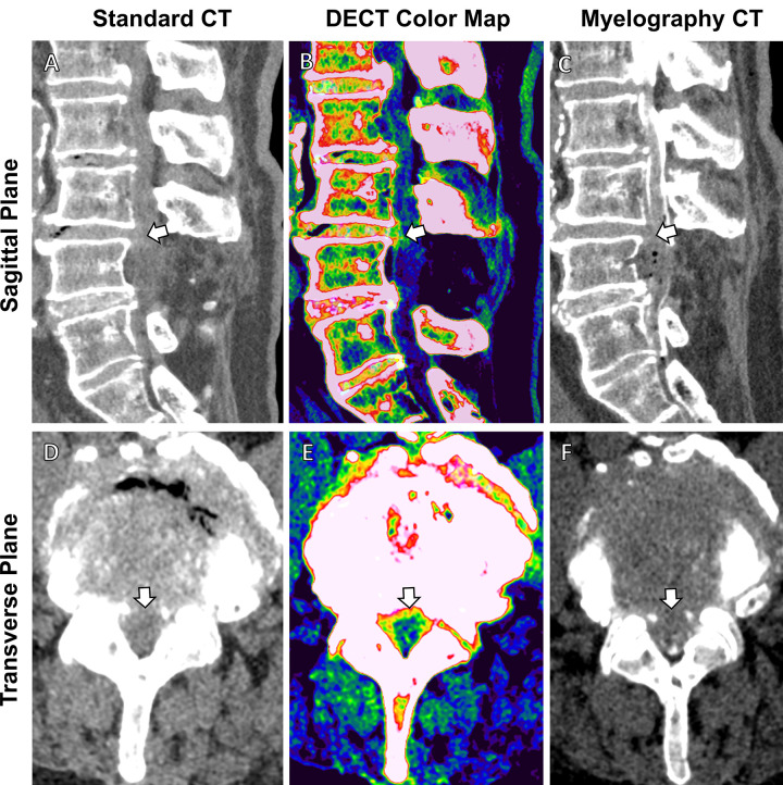 Comparison of standard CT, dual-energy CT (DECT)–based color-coding, and myelography CT in a 78-year-old woman with recurring back pain after L4 decompression surgery. (A, D) Sagittal and transverse images from standard CT are suggestive of intervertebral disk protrusion at the L3-L4 level (arrow). (B, E) These findings are confirmed in higher detail (arrow) on (B, E) axial and sagittal color map images from DECT (green indicates annulus fibrosis, nucleus pulposus, and spongy bone and/or marrow; red and salmon indicate the compact bone; and blue indicates other ligamentous tissue) and (C, F) myelography CT scans.