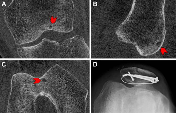 Images in a 68-year-old male patient 9 months after open reduction and internal fixation for a patellar fracture. Cone-beam CT scans in the (A) coronal, (B) sagittal, and (C) axial planes show a small subchondral cyst (arrowhead). (D) Skyline view radiograph of the same knee demonstrates the hardware used for open reduction and internal fixation; however, no subchondral cyst is detectable on the radiograph.