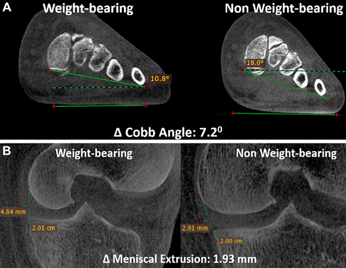 (A) Sagittal cone-beam CT (CBCT) images in a 31-year-old male patient with a 6-month history of dorsal midfoot pain. CBCT can be used to show differences in weight-bearing and non–weight-bearing states. In this example, it accurately shows reduction in coronal forefoot arch angle. (B) Sagittal CBCT images in a 55-year-old male patient with chronic knee pain. Weight-bearing CBCT and non–weight-bearing CBCT can also be used to measure enhanced meniscal extrusion during physiologic weight-bearing loads (1.3 mm change).