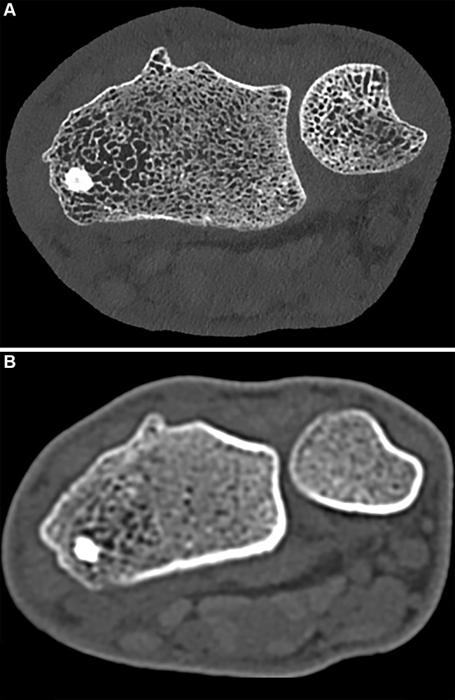 Noncontrast CT images of the distal radius in a 23-year-old male patient. (A) Ultrahigh-resolution axial photon-counting CT image (section thickness, 0.2 mm; reconstruction kernel, Br84; 120 kV; volume CT dose index, 12 mGy; window width, 500 HU; window level, 2000 HU) and (B) standard-resolution CT scan in the same patient acquired with an energy-integrating detector CT system 5 years earlier (section thickness, 1 mm; reconstruction kernel, B70; 130 kV; volume CT dose index, 15 mGy; window width, 500 HU; window level, 2000 HU; Siemens Emotion 16) show significant difference in visual resolution.