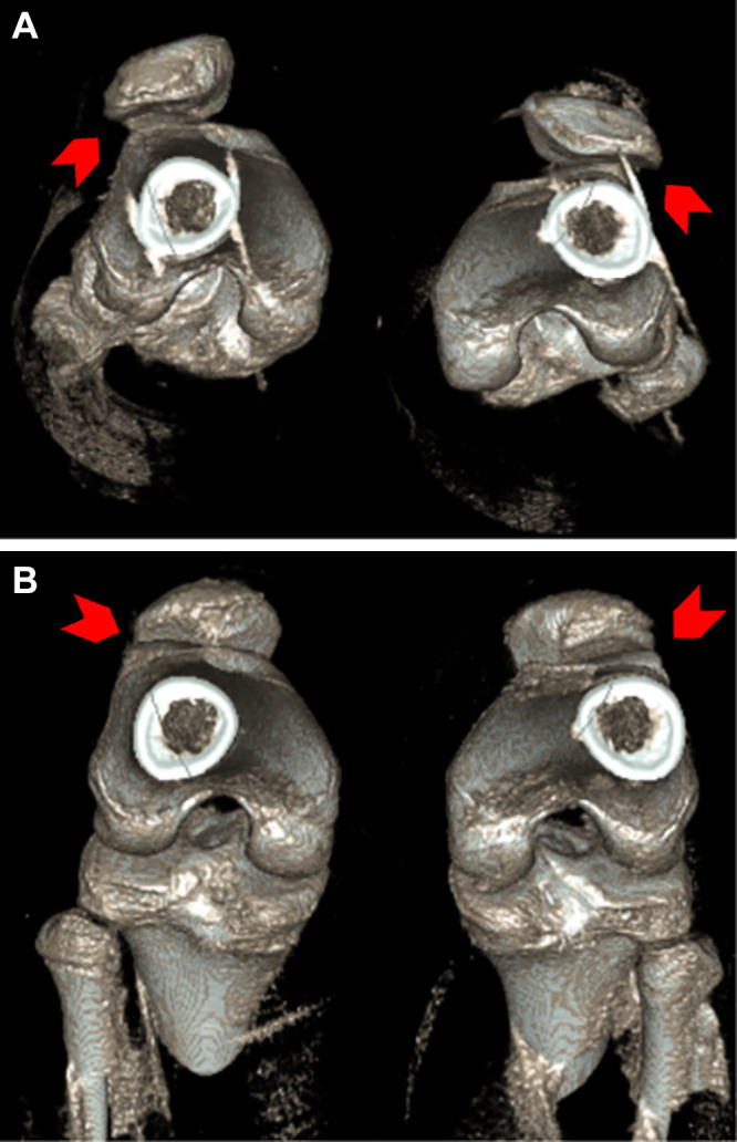 Four-dimensional CT scans in a 14-year-old female patient with patellofemoral maltracking. (A) Images obtained in full extension show subluxation of the patella with a “J-shape” patellofemoral maltracking pattern (arrowheads). (B) Subluxation is not seen (arrowheads) on images obtained full flexion (arrowheads).