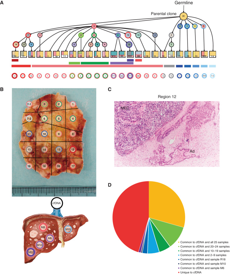 Figure 6. Geographic mapping of subclones based on multiregion WES and proposed clonal evolution of the Panc-NEC in the autopsied patient. A, Proposal clonal evolution model drawn according to the evolutional lineage tree based on VAF of the mutations (LICHeE; ref. 40) in 20 primary regions and 5 liver metastases. The numbers inside the circles are for mutations used by LICHeE to infer the subclonal structure. The colors in each subdivision describe the mutation groups characterizing cells in this subpopulation. The numbers and colors inside the squares indicate the region numbers shown in B and the composition of subpopulations, respectively. B, Macroscopic picture of the maximum section through the primary Panc-NEC. Sections are marked, corresponding to the colors of the predicted subclones based on the evolutional lineage tree. C, Microscopic picture of region 12 in the primary Panc-NEC (H&E staining). Copy-number analysis demonstrated that WGD occurred in only the adjacent regions 12, 16, and 17 (Supplementary Table S20). Adenocarcinoma component observed together with NEC only in region 12. NEC, NEC component; Ad, adenocarcinoma component. D, Pie chart showing the relationship between mutations detected in plasma cfDNA and in tissue samples (20 primary regions and 5 liver metastases).