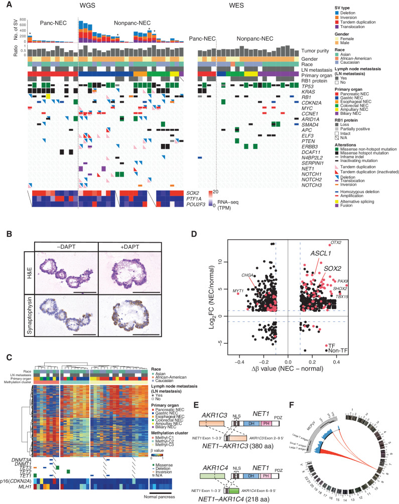 Figure 1. Genomic alterations of GIS-NECs. A, Landscape of genomic alterations in GIS-NEC cases. The left oncoplot indicates WGS data, and representative gene expression data are obtained from frozen samples. The cases are arranged from left to right according to descending order of the number of SVs in each primary organ. Asterisks, organoid samples. The right oncoplot shows WES data in patients differing from patients available on the WGS data. B, Hematoxylin and eosin (H&E) staining and synaptophysin immunolabeling of TP53 and RB1 double knockout (TR-KO) organoids before and after blocking Notch signaling with a γ-secretase inhibitor (DAPT). The synaptophysin-positive cells were increased by the Notch inhibitor. Scale bar, 100 μm. C, Unsupervised hierarchical cluster analysis with 2,000 high variant probes for DNA methylation in GIS-NECs. D, Integration of RNA-seq and DNA methylation array data comparing GIS-NECs with normal tissues. RNA-seq data were filtered using significant differentially expressed gene (DEG; abs [log2FC] ≥ 1) with significant FDR values (<0.05). DNA methylation assay data were filtered using differentially methylated regions (DMR; abs [Δβ value] ≥ 0.1) with significant adjusted P values (<0.05). In the area of the figure showing high levels of gene expression and hypermethylation, 199 DMRs are situated, of which 39 (19.6%) are transcription factors (TF; red dots) including SOX2 and ASCL1. In contrast, in the area of the figure showing high levels of gene expression and hypomethylation, 424 DMRs are situated, of which 28 (6.6%) are TFs. CHGA, chromogranin A. E, Schematic of NET–AKR fusion genes detected in two gastric NECs. The neuroepithelioma transforming gene1 (NET1) is a specific guanine nucleotide exchange factor for RhoA. Both aldo-keto reductase family 1 members C3 (AKR1C3) and C4 (AKR1C4) are reductase enzymes that play critical roles in the biotransformation of endogenous substrates such as steroids. The chimeric genes demonstrate in-frame fusion of the NET1 amino terminus (exons 1–3) and the AKR1C3 carboxyl terminus (exons 2–9) or the AKR1C4 carboxyl terminus (exons 6–9). NLS, nuclear localization signal; DH, Dbl homology; PH, pleckstrin homology; PDZ, post-synaptic density 95; aa, amino acids. F, Gastric NEC with the Merkel cell polyomavirus (MCPyV; case NE002). The read depth along the polyomavirus genome is shown in blue, and read pairs bridging the polyomavirus genome and the integration site on chromosome 8 are indicated by red lines. Polyomavirus genes are indicated by large T antigen, small T Antigen, VP1, VP2, and VP3.