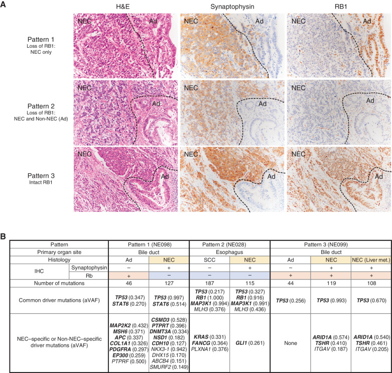 Figure 5. Bidirectional differentiation in GIS-NECs. A, Representative microscopic features of GIS-NECs with nonneuroendocrine carcinoma elements (Non-NEC; adenocarcinoma or squamous cell carcinoma). Based on RB1 immunolabeling, these GIS-NECs are classified into three patterns. Pattern 1, loss of RB1 only in the NEC component; pattern 2, loss of RB1 in both the NEC and Non-NEC components; pattern 3, intact RB1 in both the NEC and Non-NEC components. The NEC components are positive for synaptophysin in all cases. NEC, NEC component; Ad, adenocarcinoma component. B, In three cases of GIS-NECs with Non-NEC elements (adenocarcinoma or squamous cell carcinoma), NEC and Non-NEC components were separately macrodissected from FFPE materials. WES was performed for each component. The table shows driver mutations (TVAF ≥ 0.1) identified by OncodriveMUT (39) in the NEC and Non-NEC components in these cases. The genes in bold font are listed in the COSMIC Cancer Gene Census. SCC, squamous cell carcinoma component; aVAF, variant allele frequency adjusted to tumor purity; Liver met., liver metastasis.