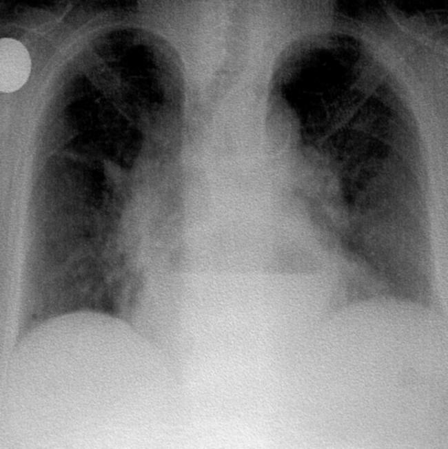 Paraoesophageal hiatal hernia as a rare cause of dyspnoea pmc