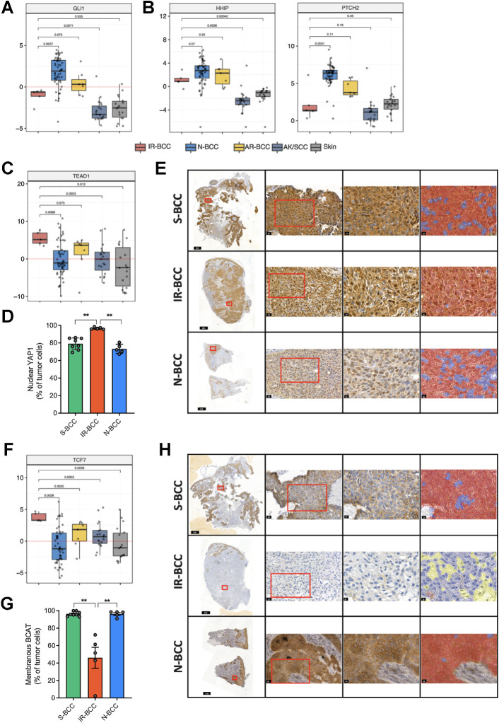 Figure 4. Transcriptional activity and immunohistochemical analysis of the Hedgehog, Hippo-YAP, and WNT markers in BCC. A, Relative activity of the central Hedgehog TF GLI1 based on the expression of its transcription targets in different groups of skin tumors and normal skin. B, RNA expression (logTPM values) of the HHIP and PTCH2 genes which are usually activated in BCC. C, Relative activity of the central HIPPO-YAP TF TEAD1 based on the expression of its transcription targets in different groups of skin tumors and normal skin. D, Quantification of nuclear YAP1 protein expression in tumor cells (% of total tumor cells) among the three groups of samples assessed by YAP1 enzymatic IHC. E, Representative micrographs for YAP1 expression in BCC groups at various magnifications: tumor overview on the whole-slide scan (first column), details of the regions marked with a red square in the first column (20× magnification, second column), and details of regions marked with red square in the second column (40× magnification, third column) with overlapping color mask (fourth column) marking nuclear YAP1-positive cells (red mask). Nuclear YAP1-negative tumor cells are marked in blue. The parts of the image are intentionally duplicated in Supplementary Figs. S2–S4 for S-BCC, IR-BCC, and N-BCC samples, respectively, as the same slides represented. F, Relative activity of the central WNT TF TCF7 based on the expression of its transcription targets in different groups of samples. G, Quantification of membranous BCAT expression in the tumor cells (% of total tumor cells) in the three groups of samples assessed by BCAT enzymatic IHC. H, Representative micrographs for BCAT expression in BCC groups at various magnifications: tumor overview on the whole-slide scan (first column), details of the regions marked with a red square in the first column (20× magnification, second column), and details of regions marked with red square in the second column (40× magnification, third column) with overlapping color mask (fourth column) marking membranous BCAT-positive cells (red mask). BCAT-negative tumor cells are marked in blue and nontumor cells are marked in yellow. The parts of the image are intentionally duplicated in Supplementary Figs. S6–S8 for S-BCC, IR-BCC, and N-BCC samples, respectively, as the same slides represented.