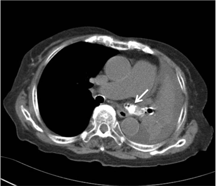 A Case Of Significant Endobronchial Injury Due To Recurrent Iron Pill 