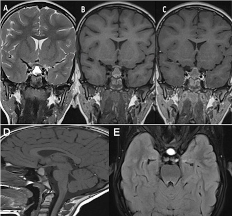 Coronal T2WI (A), T1WI (B), post-contrast T1WI (C), sagittal T1WI (D) and axial FLAIR (E) images demonstrate a sellar and suprasellar lesion with heterogeneous content in the lower part of the lesion and peripheric enhancement