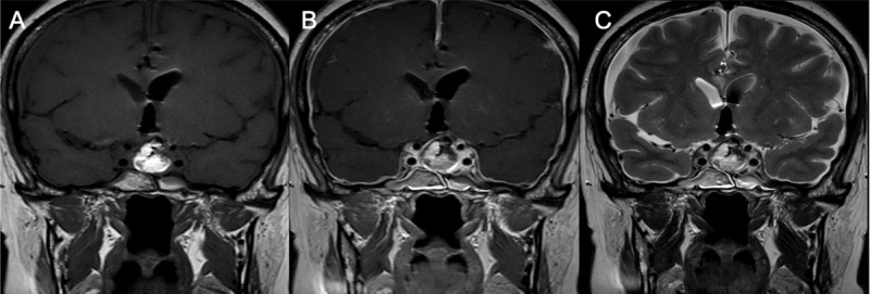 MRI after first surgery: Coronal T1WI (A), Coronal post-contrast T1WI (B) and coronal T2WI revealed signs of intracranial hypotension: right and left subdural collections and pachymeningeal thickening and enhancement