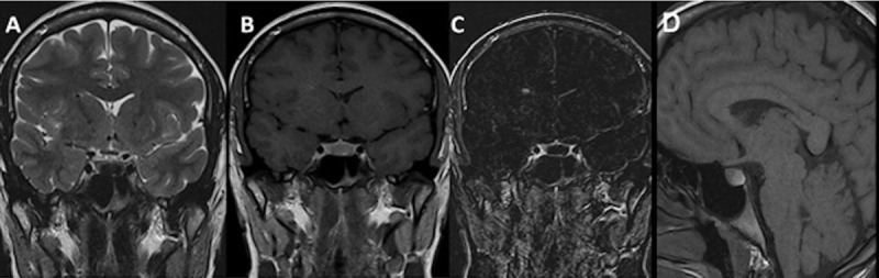 Intrasellar lesion in a 22-year-old female patient with a hypointense component on coronal T2WI (A), which is hyperintense on coronal (B) and sagittal (D) T1WI, and without enhancement on coronal contrast-enhanced substracted T1WI (C) diagnosed as Rathke’s cleft cyst pathologically