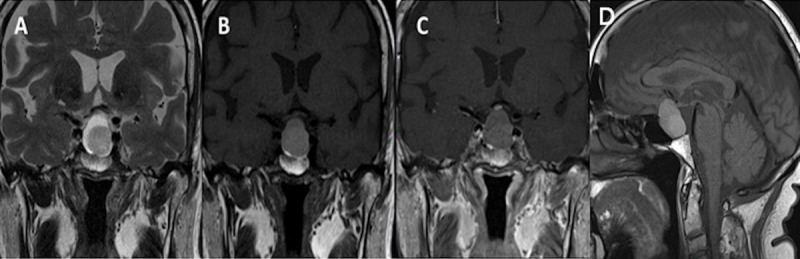 Ten-year follow-up of the same patient: Coronal T2WI (A), T1WI (B), post-contrast T1WI (C) and sagittal T1WI (D) show an increase in size of the lesion as well as the intracystic nodule