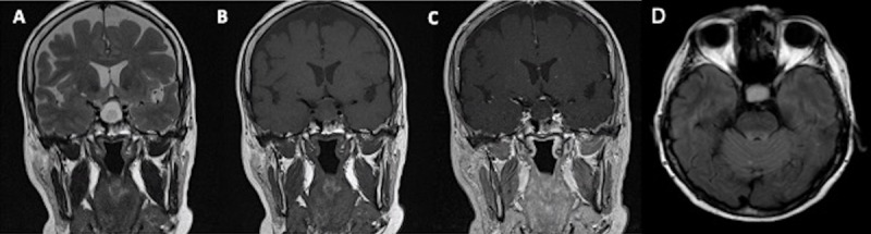 Coronal T2WI (A), coronal T1WI (B), coronal contrast-enhanced T1WI (C) and axial FLAIR (D) images in a 73-year-old female patient show cystic intrasellar and suprasellar lesion with a non-enhancing intracystic nodule hyperintense to surrounding fluid on T1 and hypointense on T2