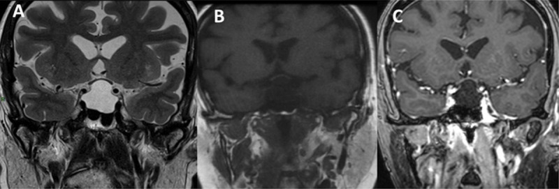 Intrasellar and suprasellar lesion in a 67-year-old female patient, which is hyperintense in on coronal T2WI (A), hypointense on coronal T1WI (B), and no enhancement is observed on contrast-enhanced T1WI (C) diagnosed as Rathke’s cleft cyst pathologically