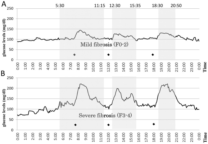 Twenty-four-hour sensor glucose profiles by continuous glucose monitoring system.