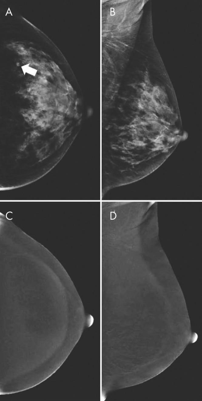 A, B, Contrast-enhanced mammographic (CEM) images in 52-year-old woman recalled from screening for new ill-defined mass (arrow in A) visible on, A, low-energy craniocaudal view but not visible on, B, low-energy mediolateral oblique view. C, D, Subsequent evaluation of recombined CEM images revealed no suspicious enhancement. Targeted US showed no lesions, but because of small lesion size, patient was categorized as having Breast Imaging Reporting and Data System category 3 lesion (follow-up after 6 months showed no breast cancer). Two subsequent rounds of screening (up to 4 years after primary evaluation) revealed no breast cancer.