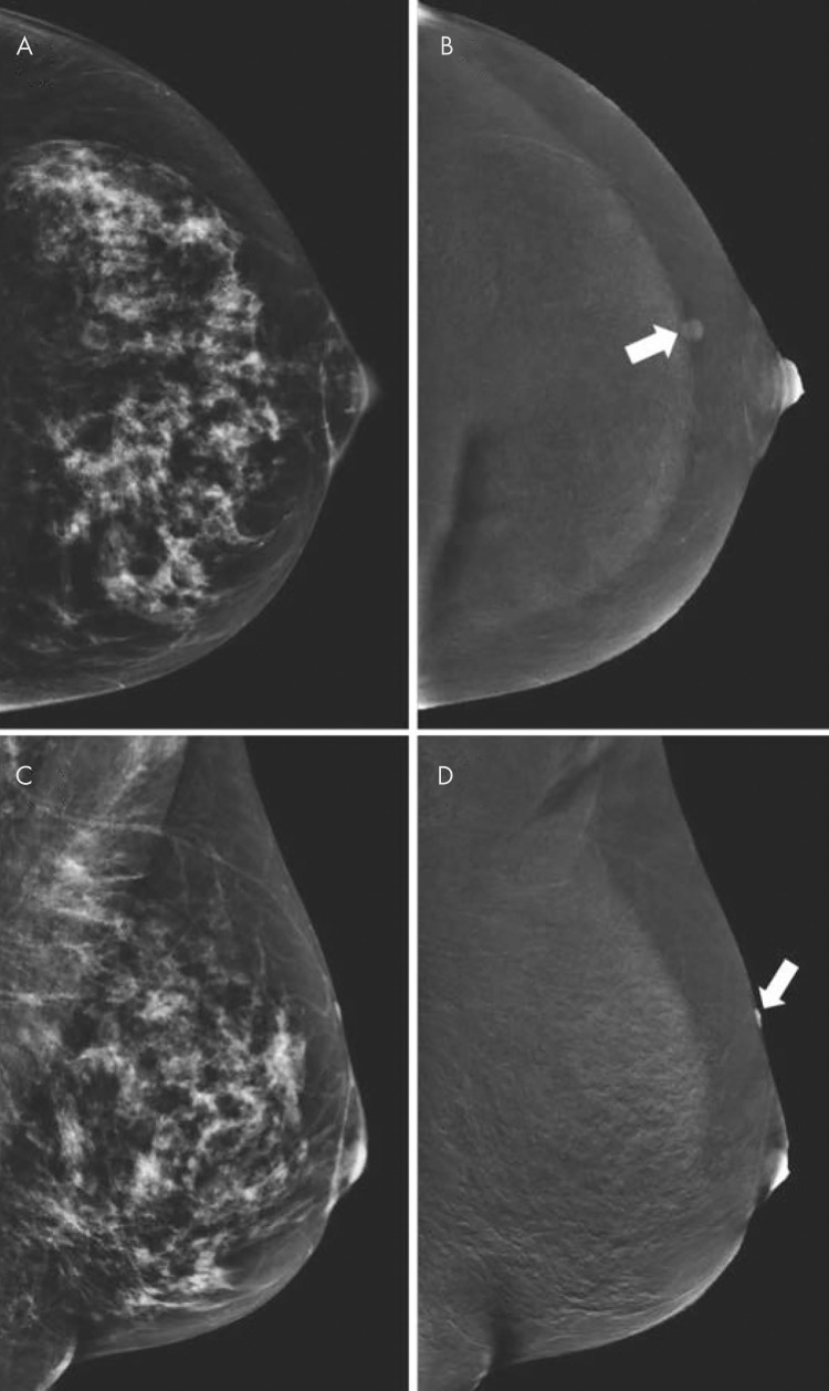 Contrast-enhanced mammographic images of enhancing benign lesion in 50-year-old woman. A, Low-energy craniocaudal image. B, Contrast-enhanced recombined craniocaudal image. C, Low-energy mediolateral oblique image. D, Contrast-enhanced recombined mediolateral oblique image. Contrast-enhanced craniocaudal view of left breast demonstrates a small, well-defined enhancing mass (arrow in B). Mediolateral oblique view of same breast demonstrates that lesion is located on skin (arrow in D). Visual inspection revealed skin hemangioma.