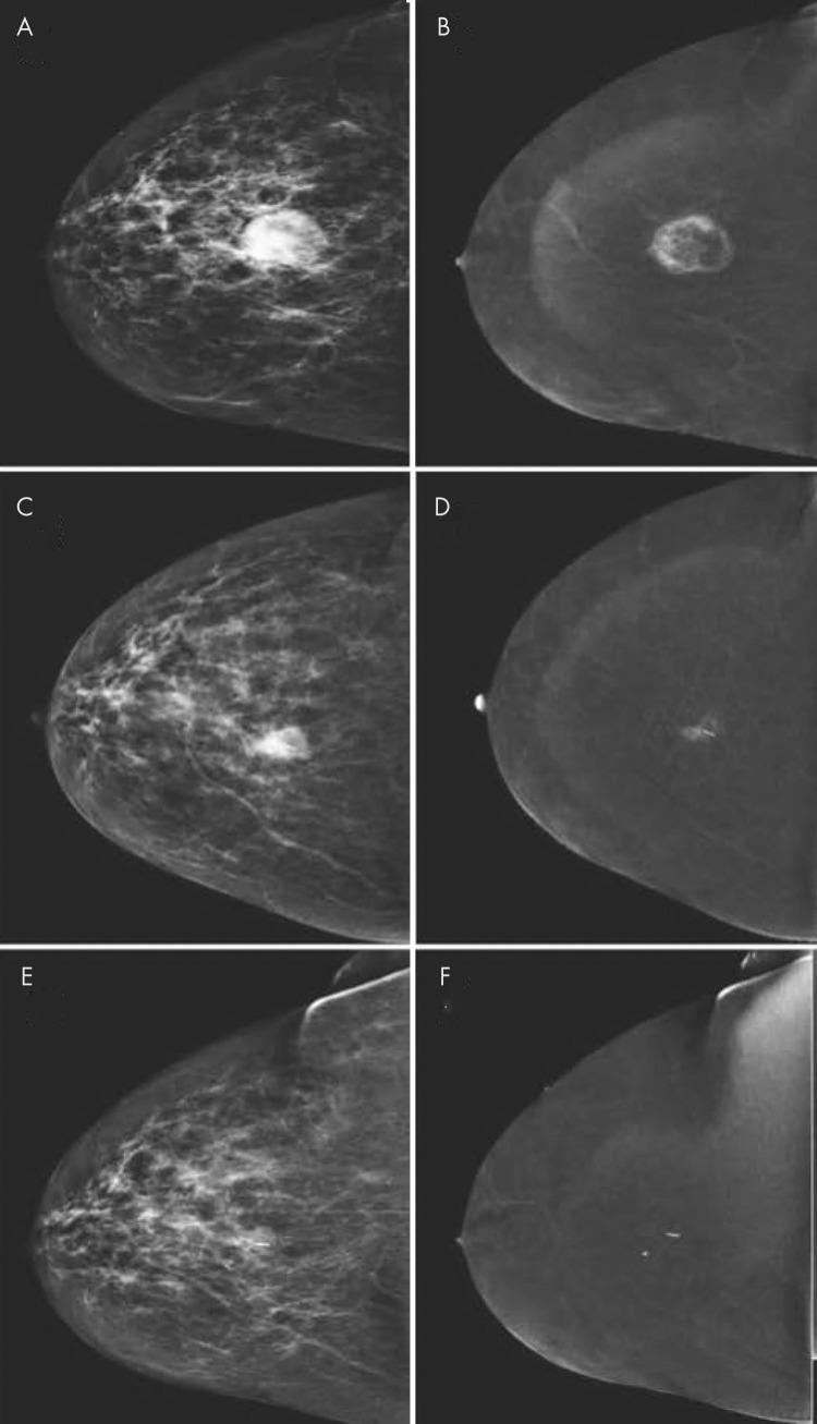 Images of response monitoring using contrast-enhanced mammography in a 54-year-old woman diagnosed with 3.0-cm invasive breast cancer of no special type (grade 3, estrogen receptor negative, progesterone receptor negative, and human epidermal growth factor receptor type 2 positive). A, Low-energy image in craniocaudal view shows cancer. B, Recombined image shows peripheral enhancement, which is suggestive of central necrosis. The patient underwent neoadjuvant systemic therapy. C, Low-energy, and, D, recombined craniocaudal views obtained during treatment show decrease in index tumor size (C) with decrease in enhancement (D). E, Low-energy and, F, recombined images obtained after completion of therapy. There was no residual mass on low-energy image. Resolution of enhancement on recombined image was consistent with complete radiologic response. Surgical specimen showed pathologic complete response without any residual ductal carcinoma in situ.