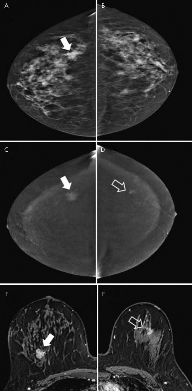 Images obtained for disease extent assessment in 64-year-old woman recalled from screening for irregular mass in right breast. A, Low-energy image of right breast (craniocaudal view) shows irregular mass (arrow). B, No lesion is seen on low-energy image in contralateral breast. C, Image from contrast-enhanced mammography (CEM) (right craniocaudal view) shows enhancement of mass (arrow). D, CEM image shows contralateral irregular enhancing mass (arrow), which was not visible on low-energy image. E, F, Contrast-enhanced MRI scans of, E, right breast and, F, left breast show both lesions (arrow). Lesions were diagnosed as invasive breast cancer of no special type (estrogen receptor positive, progesterone receptor positive, and human epidermal growth factor receptor type 2 negative).