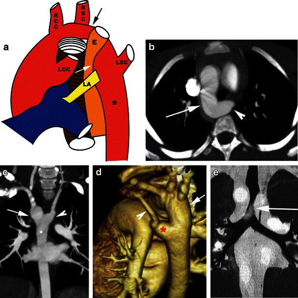 Computed tomography in the evaluation of vascular rings and slings - PMC