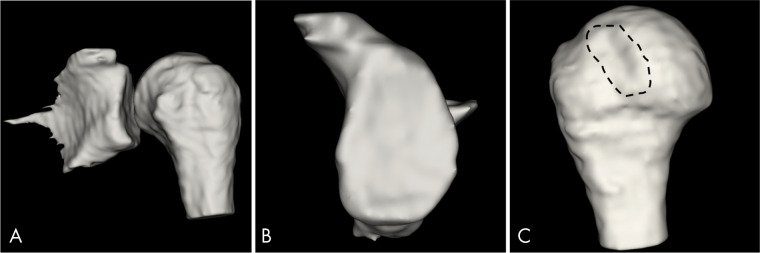 Three-dimensional (3D) MRI bone models, fully automated segmentation by 3D convolutional neural network for 3D water-only Dixon-based sequence postprocessed with 3D volume surface mask. A, 3D MRI bone model of glenohumeral joint created by the selection of a threshold range of 1.00 to 3.00 of volume intensity from a 28-year-old man with previous history of anterior shoulder instability. B, “En face” view of the 3D MRI glenoid model obtained with a range of 1.00 to 1.01 volume intensity shows no clinically significant glenoid bone loss and C, shows a Hill-Sachs lesion (dashed line) at the 3D MRI humeral head model obtained with a range of 2.99 to 3.00 of volume intensity.