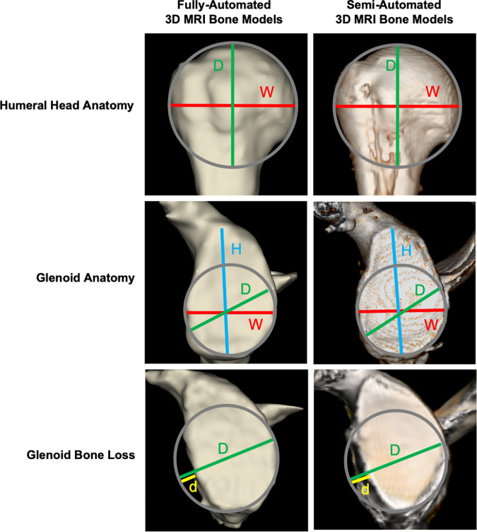 Comparison between the segmented fully automated and semiautomated three-dimensional (3D) MRI models. The following measurements, in millimeters, were performed on the different 3D models: red lines for width (W), blue lines for height (H), green lines for diameter (D), and yellow lines for the size of glenoid bone loss (d) using the best-fit circle method. In each row of the figure, there is a comparison between a fully automated 3D model and semiautomated 3D model for the same patient, with the first column consisting of fully automated 3D models generated by the deep learning–based method and the second column containing the semiautomated 3D models.