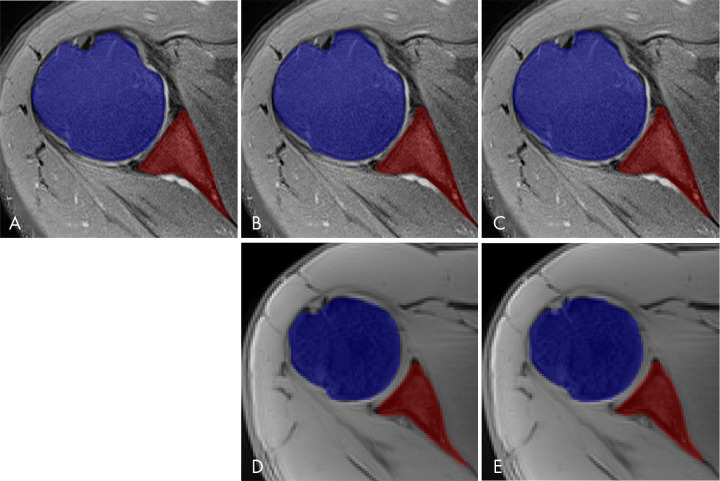 Comparison between different segmentation masks of glenohumeral joint bones. Multiple segmentation masks of the same patient where blue represents humeral head and red represents glenoid. A, Manual segmentation mask performed by a musculoskeletal radiologist using free open-source software (ITK-SNAP), overlapping an axial fat-suppressed proton density–weighted slice of shoulder, which was used as ground truth for training and to evaluate the deep learning model and fully automated segmentation masks generated by a trained deep learning algorithm using B, two-dimensional (2D) convolutional neural network (CNN) and C, three-dimensional (3D) CNN U-Net–based architecture through supervised learning of an axial 2D fat-suppressed proton density–weighted MRI dataset. D, 2D CNN and E, 3D CNN U-Net–based architectures generated fully automated segmentation masks for a different patient through transfer learning of a 3D water-only Dixon-based dataset performed by a deep learning algorithm.