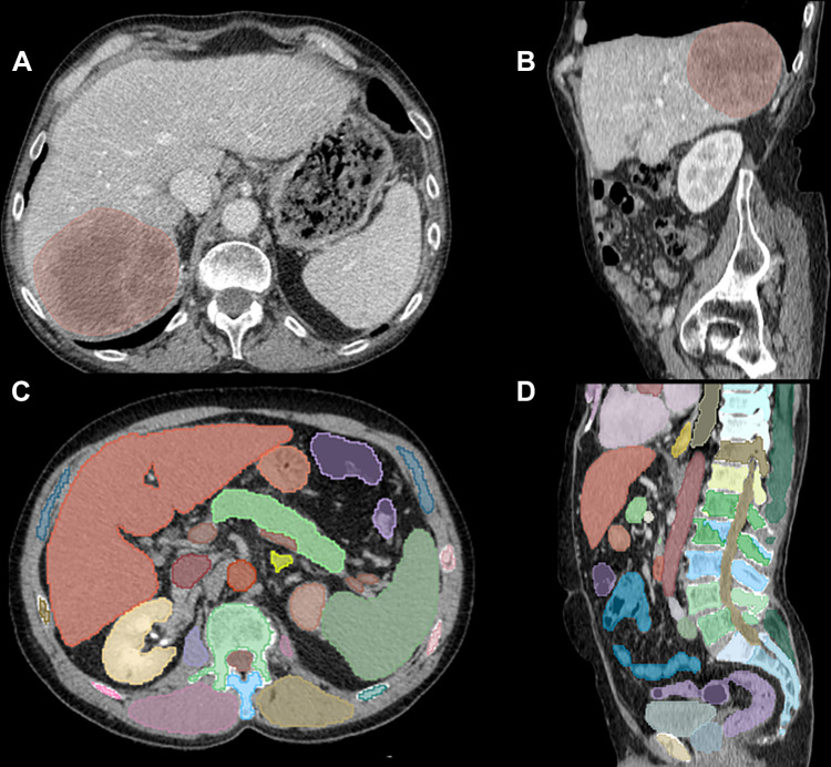 Additional visual examples of segmented contrast-enhanced CT images: manual tumor segmentations in the axial and sagittal planes, respectively (A, B), and deep learning organ volumes of interest in the axial and sagittal planes, respectively (C, D).